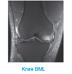 Knee BML