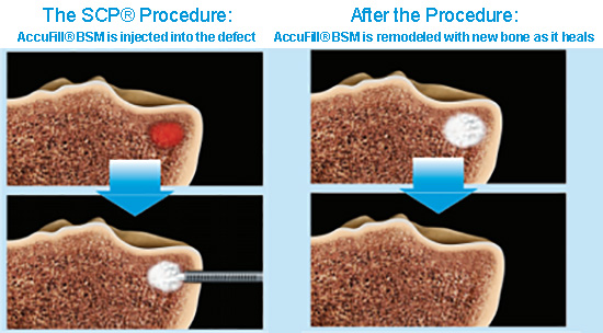 SCP Procedure